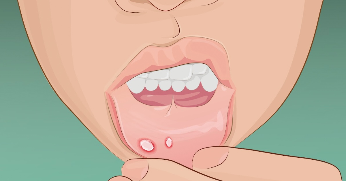 Aphthen im Mund: 5 Hausmittel, die helfen