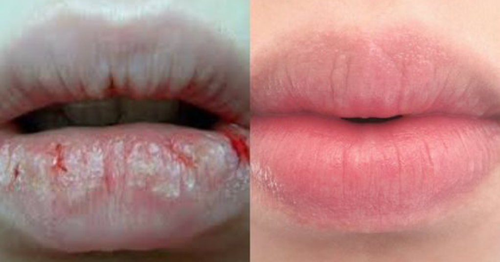 links: spröde Lippen, rechts: gepflegte Lippen.