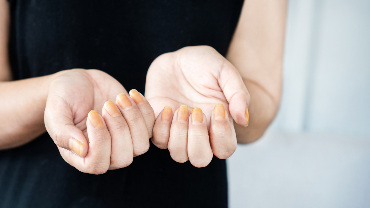 Eine Frau schaut sich ihre verfärbten Fingernägel an.