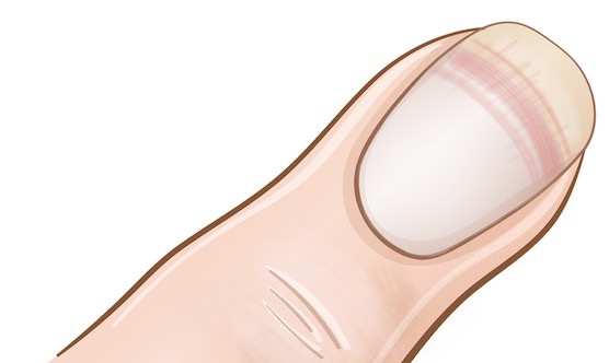 Die Illustration eines weiß gefärbten Nagels.