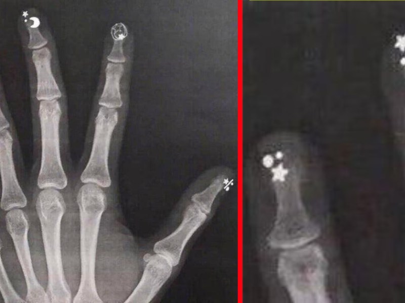 Geröntgte Hand mit künstlichen Fingernägeln