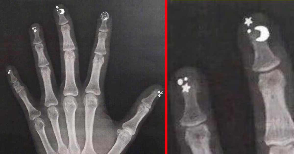 Geröntgte Hand mit künstlichen Fingernägeln