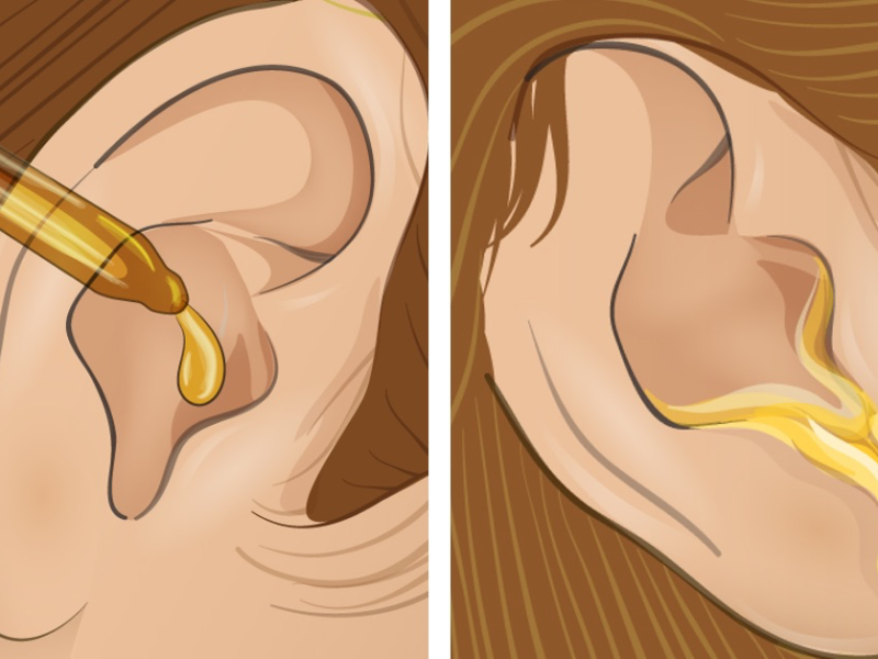 Verstopftes Ohr mit Öl reinigen.