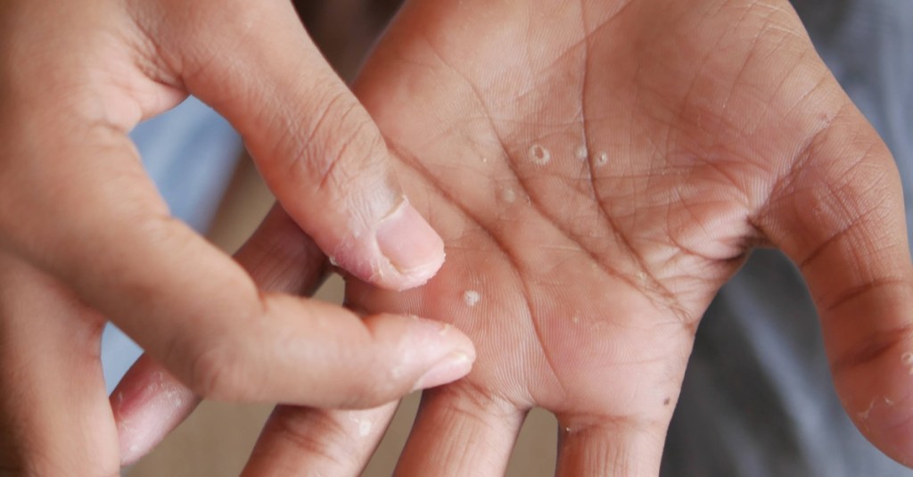 Dyshidrosis: Bläschen auf der Hand.