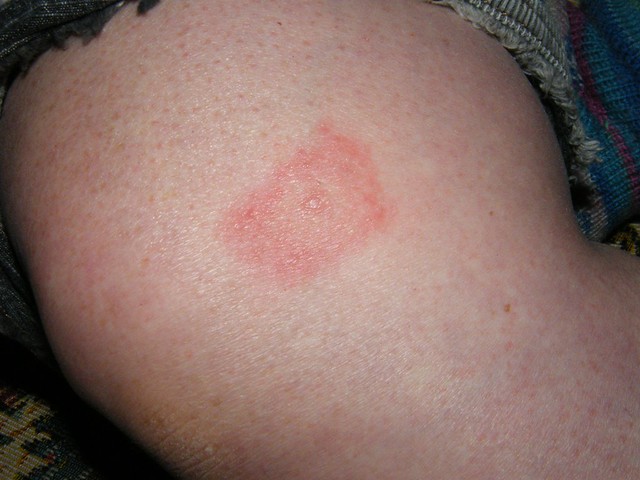 Lyme disease