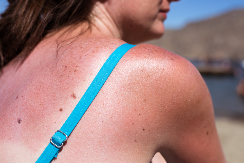 Eine Frau mit Sonnenbrand auf dem Rücken.