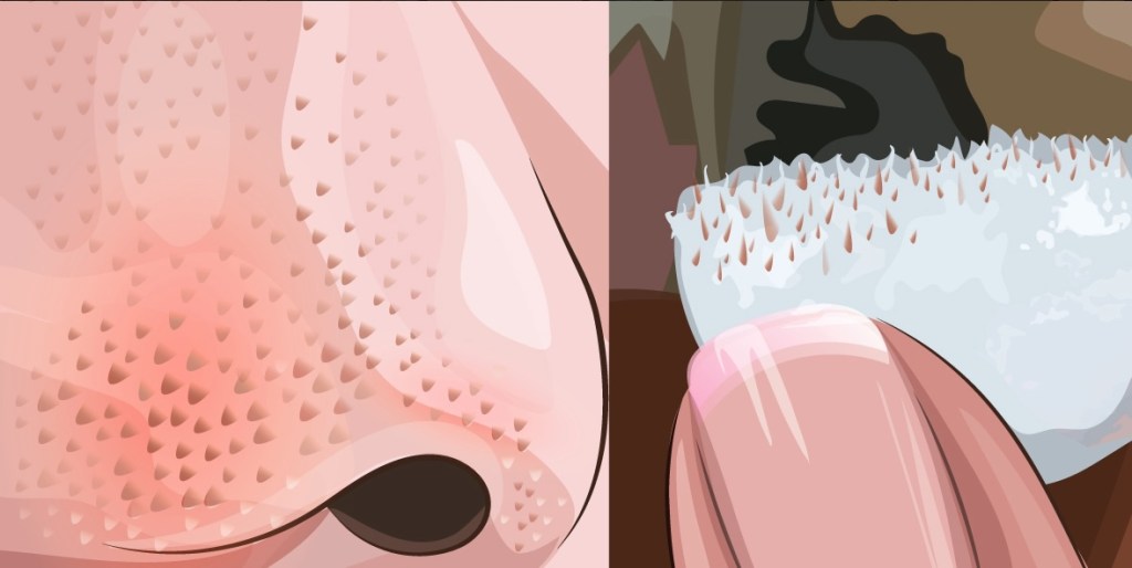 links: Die Illustration einer Nase mit Mitessern, rechts: Entfernte Mitesser auf einem Wattebausch.