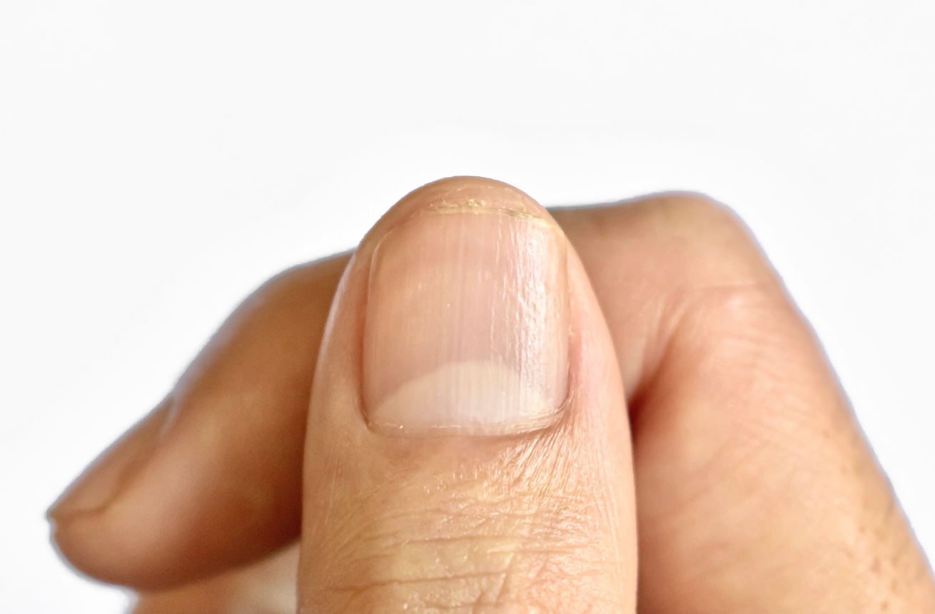 Ein Fingernagel, bei dem die Lunula gut ausgeprägt ist. Der weiße Halbmond gibt Aufschluss über die Gesundheit.