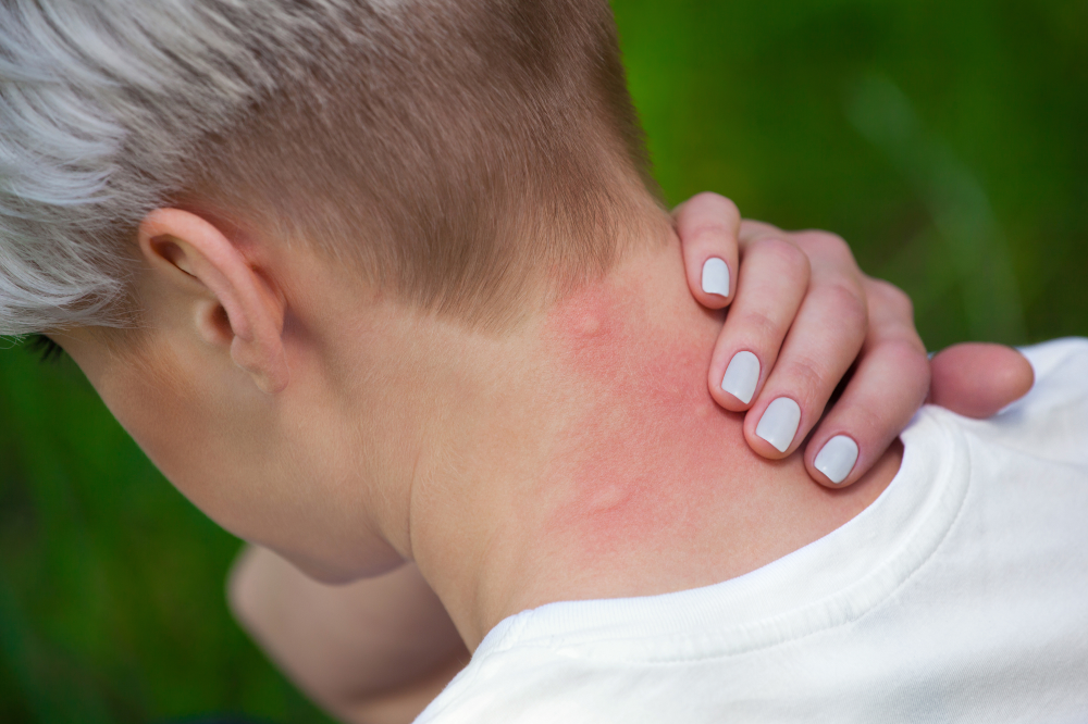 Juckende MÃ¼ckenstiche am Hals. Mit einem MÃ¼ckenspray aus WeichspÃ¼ler kannst du die MÃ¼cken vertreiben.