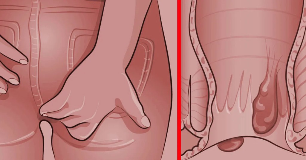 Hausmittel gegen Hämorrhoiden