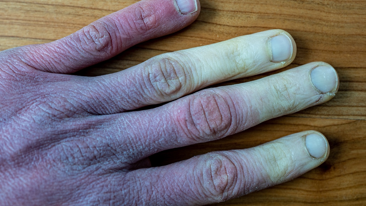 Leichenfinger: Hinter dem Phänomen steckt das Raynaud-Syndrom.