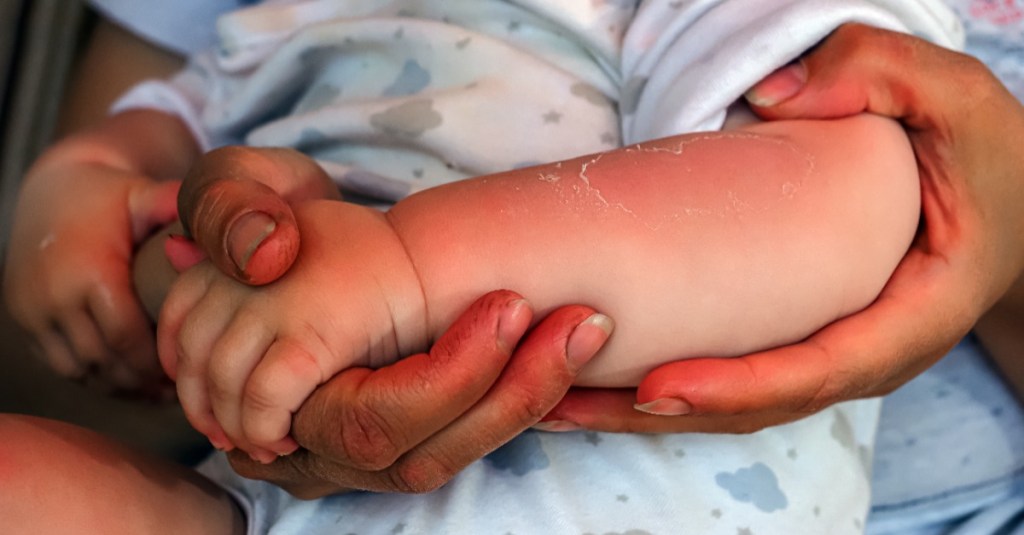 Baby mit einem Sonnenbrand auf dem Arm