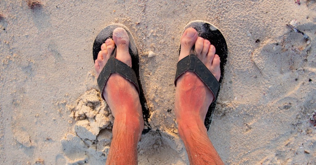 Von der Sonne verbrannte Fußrücken in Flip Flops