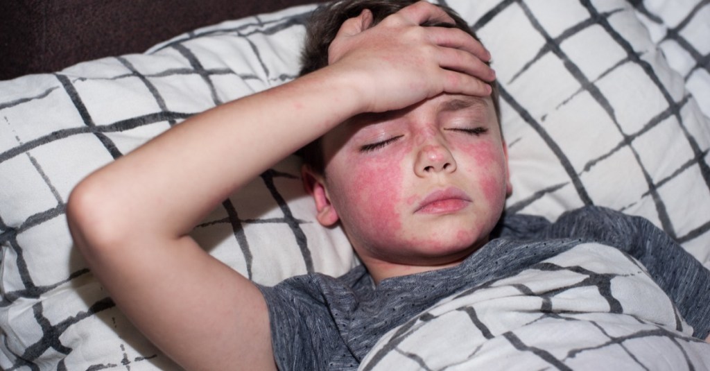 Ein Junge liegt im Bett, hält sich die Stirn, sein Gesicht ist stark gerötet.