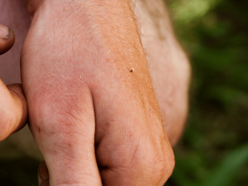 Eine Hand, in der ein Stechel von einer Biene oder Wespe sticht.