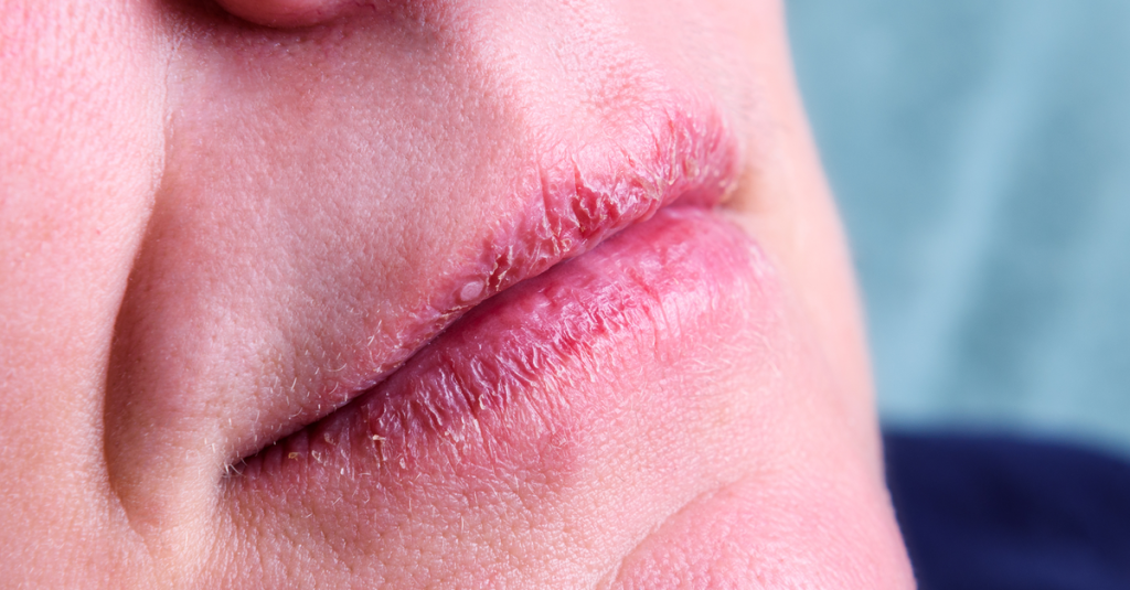 Trockene Lippen